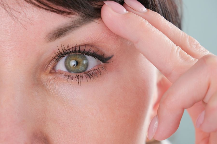 Blefaroplastia sem corte: como rejuvenescer o olhar e tratar a flacidez das pálpebras sem cirurgia